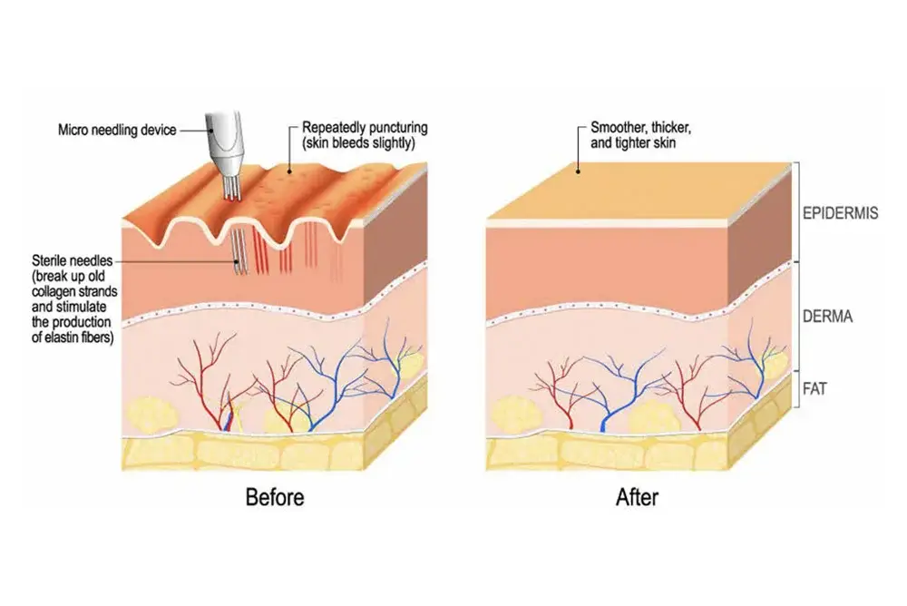 Microneedling RF - Image 2