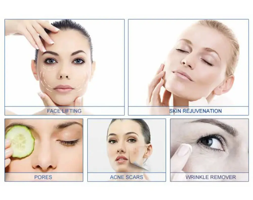 Microneedling RF - Image 3
